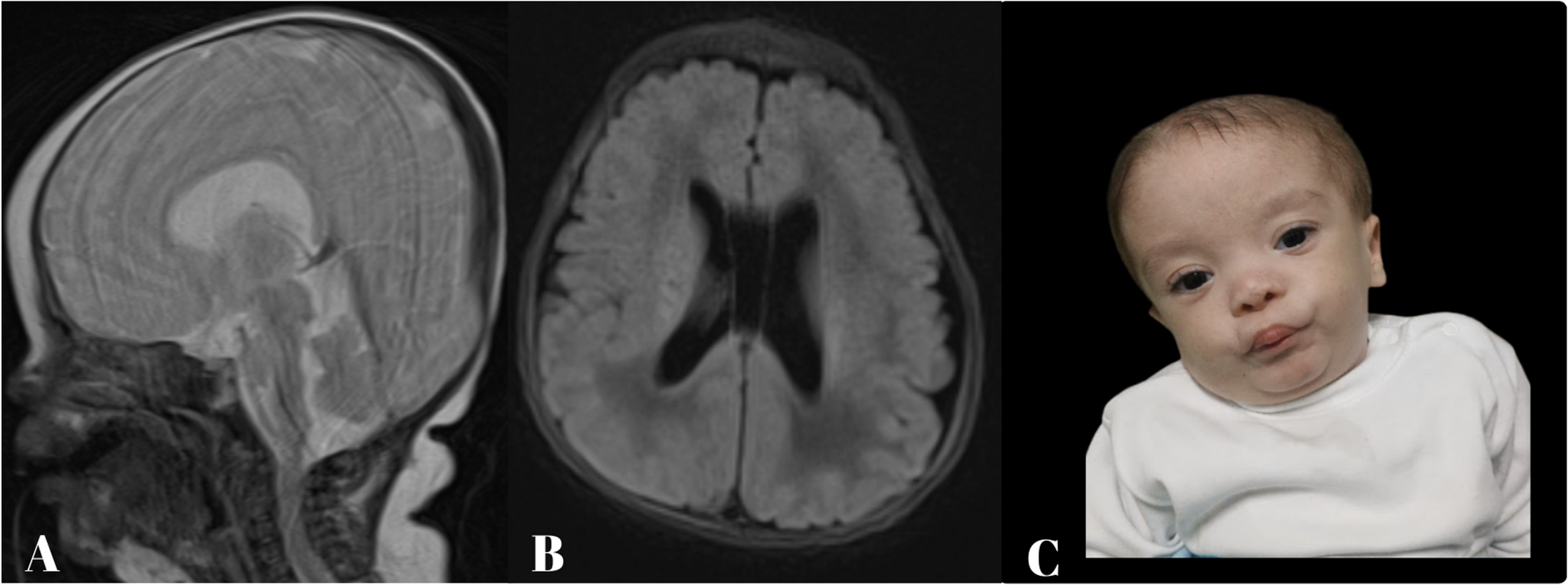 -related rare X-linked multiple congenital anomalies and neurodevelopmental syndrome: clinical findings and review of the literature