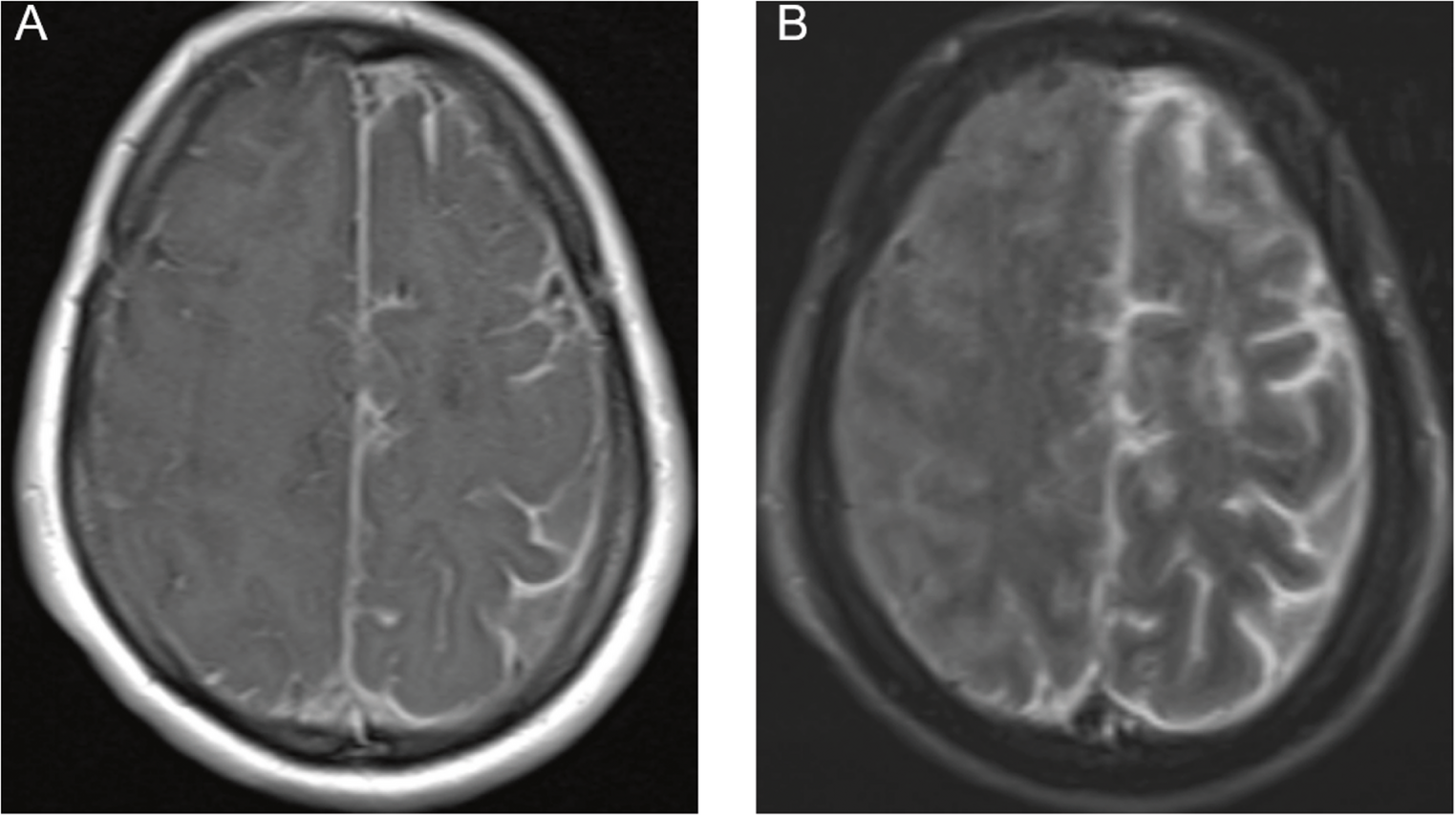 Probable cerebral amyloid angiopathy - related inflammation in a 32-year-old woman with down syndrome