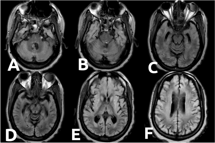 A Surprising Finding: Abnormal Eye Movements in a Patient with Diffuse Hypoxic Ischemic Brain Injury