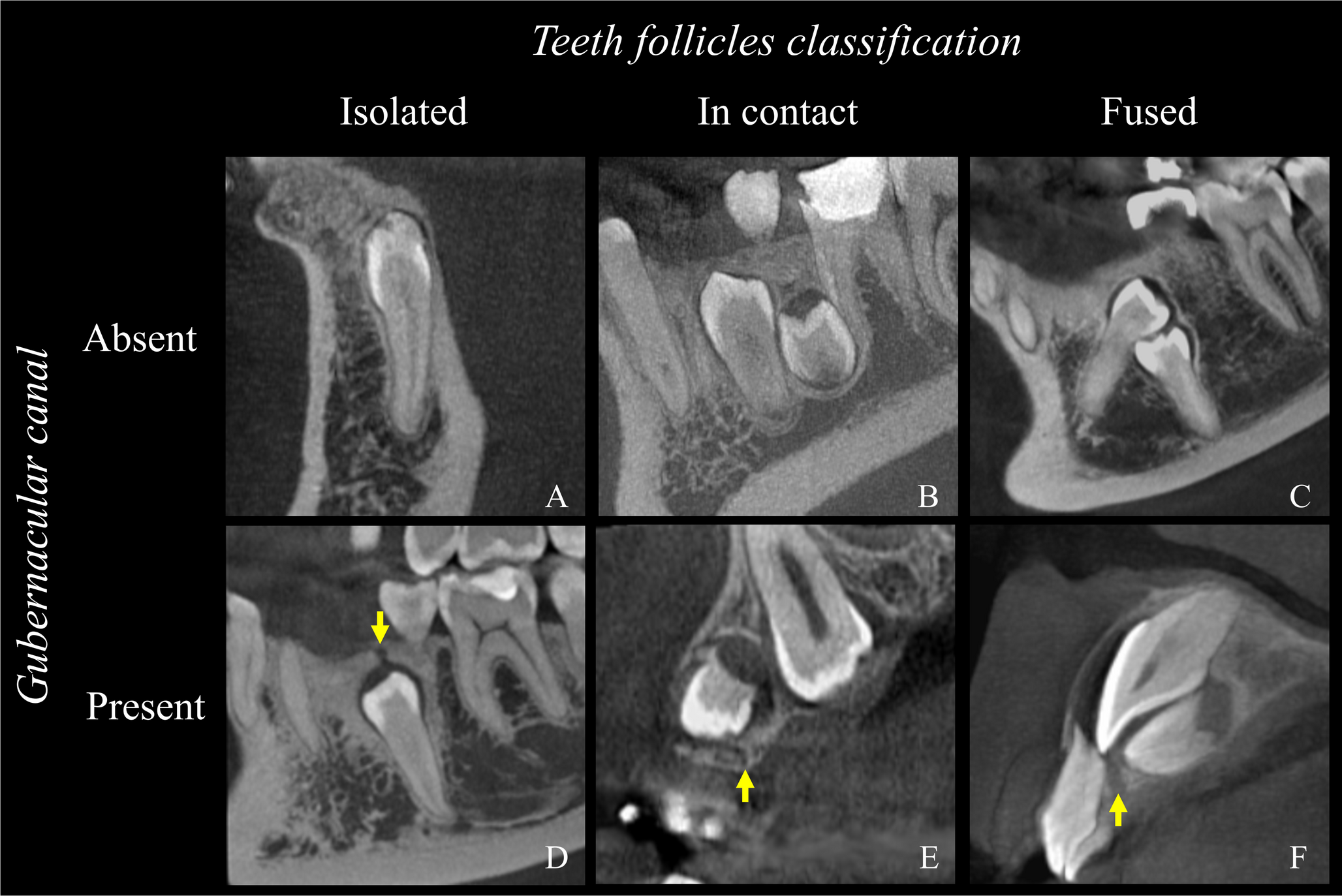 Relationship between dental follicle, gubernacular canal and developmental theories in supernumerary teeth from different regions of the jaws