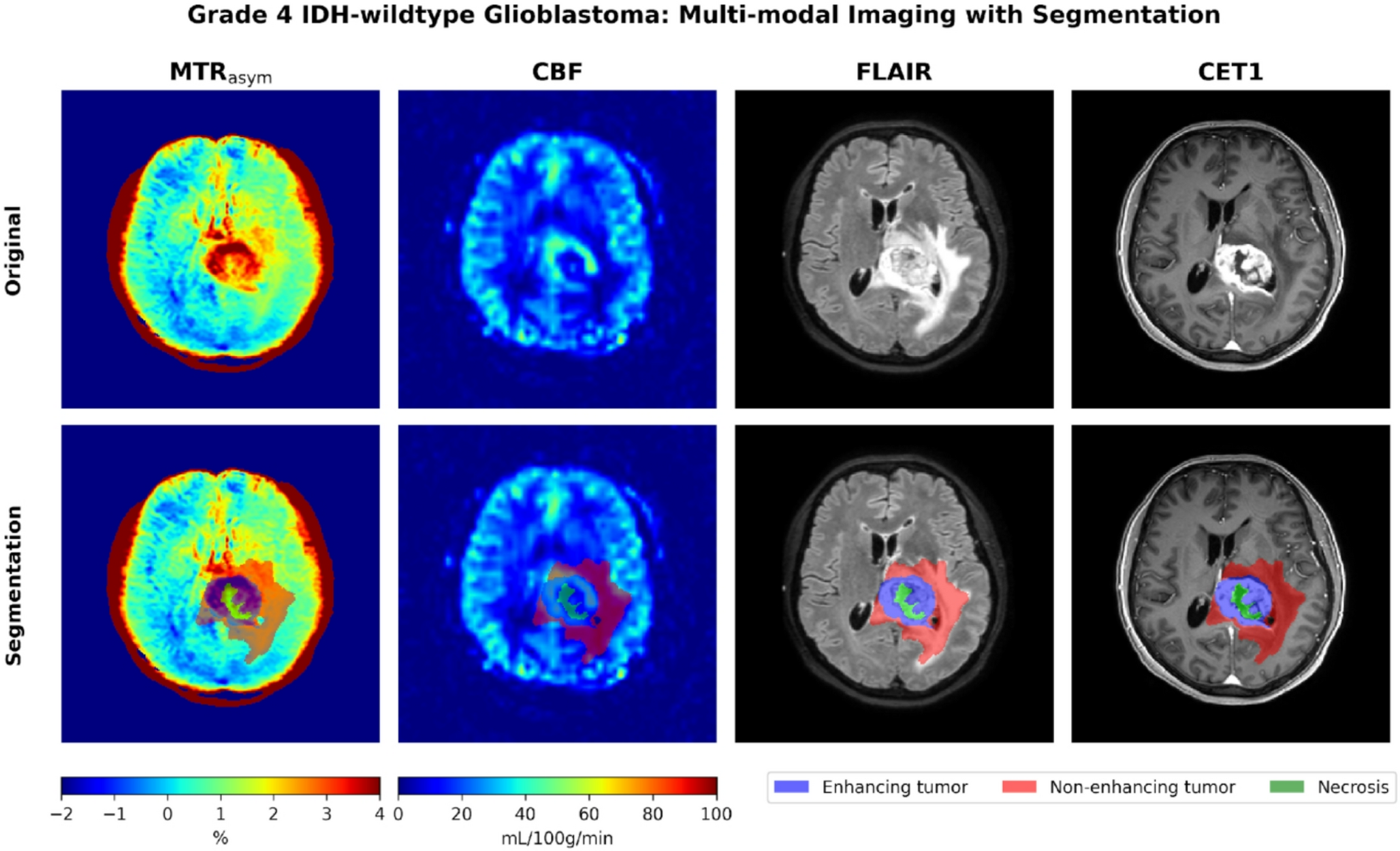 Amide proton transfer and arterial spin labeling for non-invasive molecular stratification of glioma: a multi-dataset imaging biomarker study