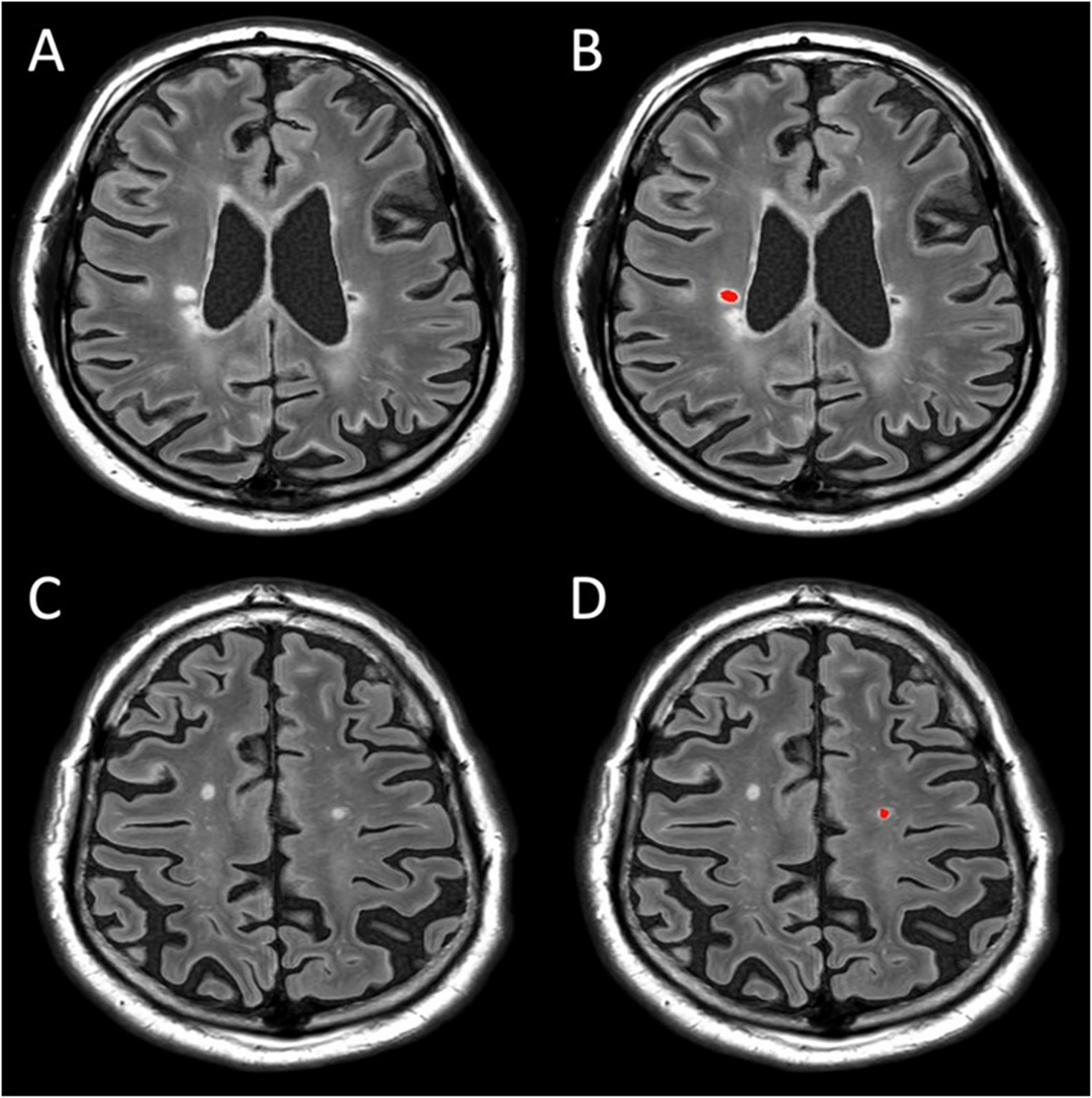 Pathological signatures of white matter lesions in multiple sclerosis versus stroke: a synthetic MRI study