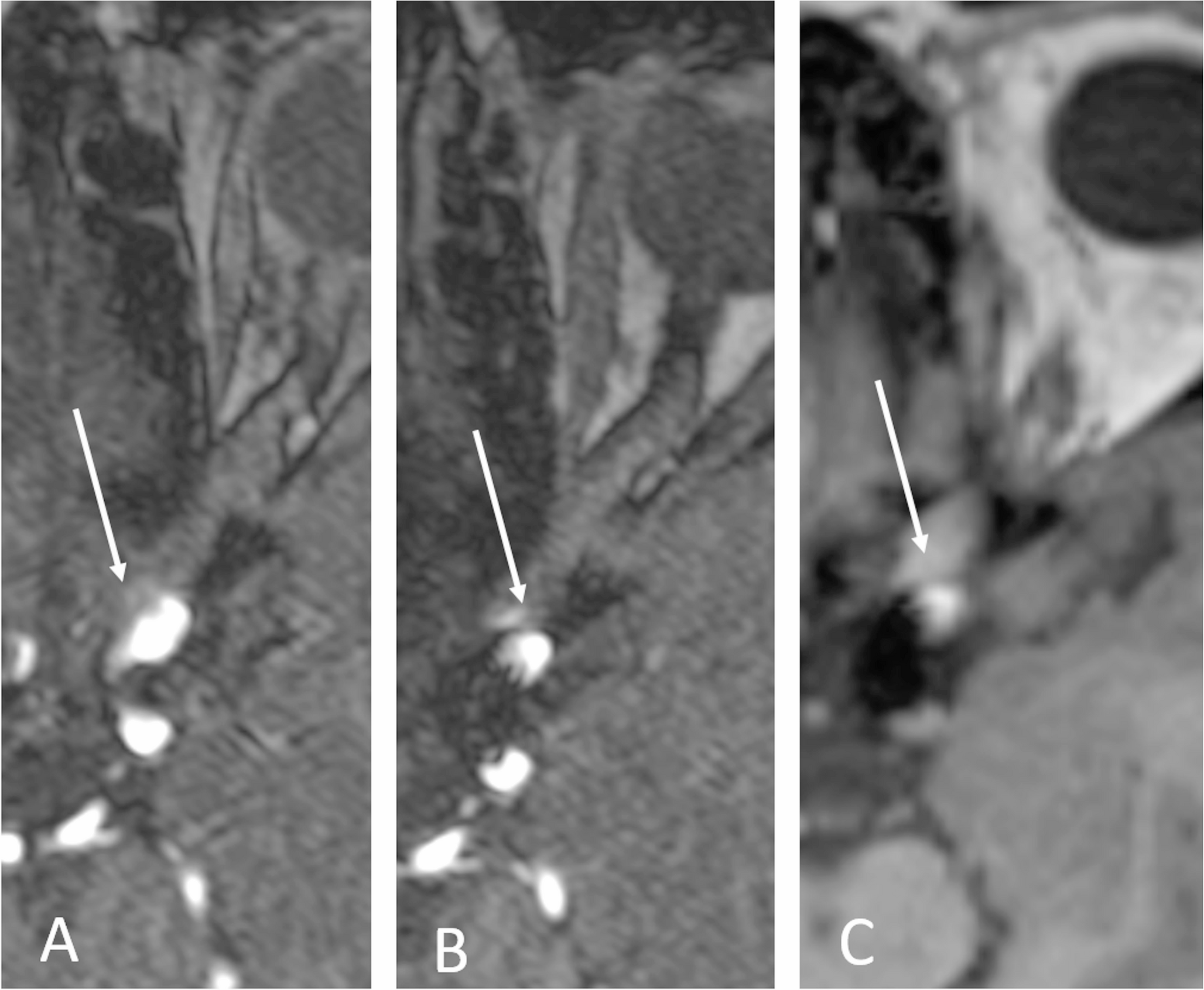 The value of non-contrast and contrast-enhanced time-of-flight magnetic resonance angiography in the follow-up assessment of cerebral aneurysms treated with flow diverter stents
