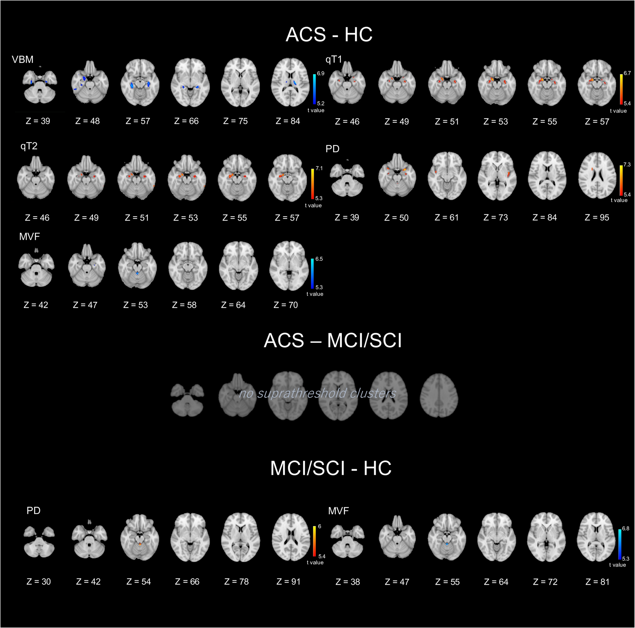 3D quantitative synthetic MRI for assessing Alzheimer’s clinical syndrome, subjective cognitive impairment, and mild cognitive impairment