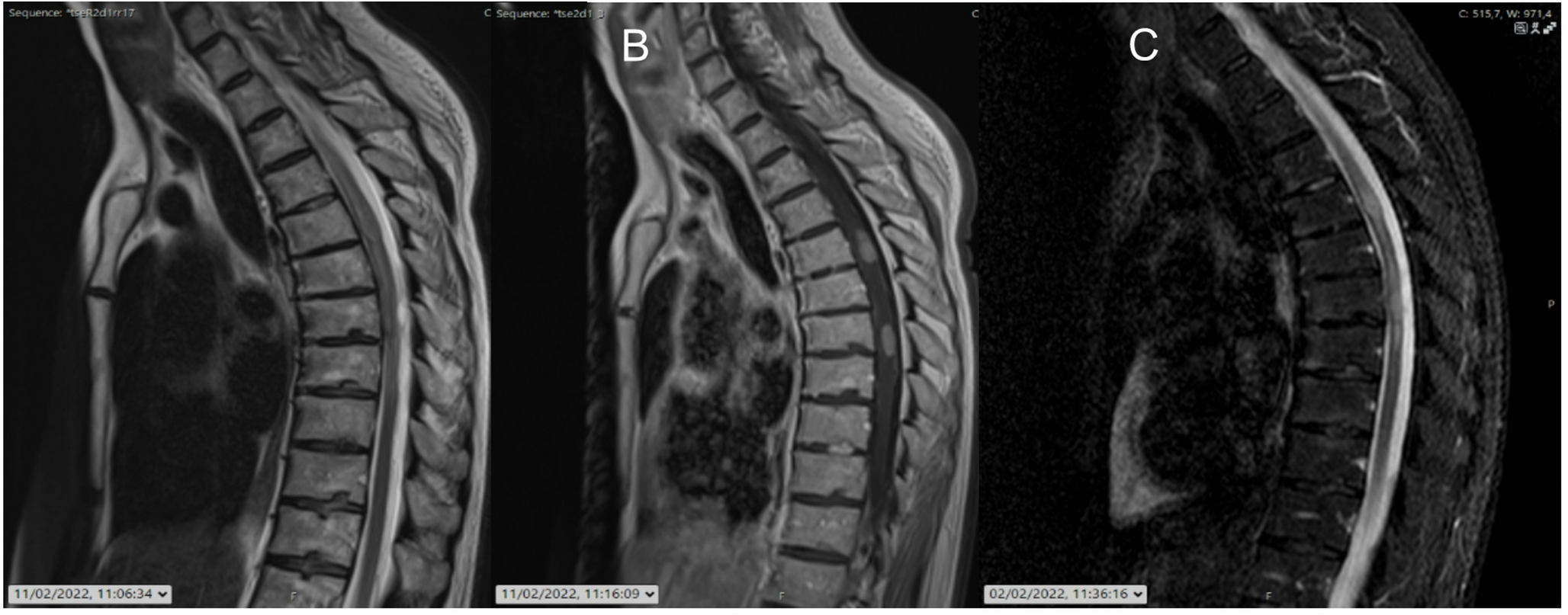 Real-world challenges in primary central nervous system lymphoma: a case series