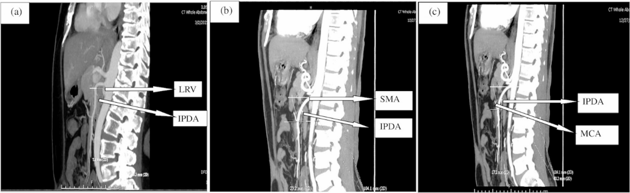 Three-Dimensional Vascular Reconstruction of the Peripancreatic Vessels on MDCT Images Facilitates Identification and Early Ligation of Inferior Pancreaticoduodenal Artery during Pancreaticoduodenectomy
