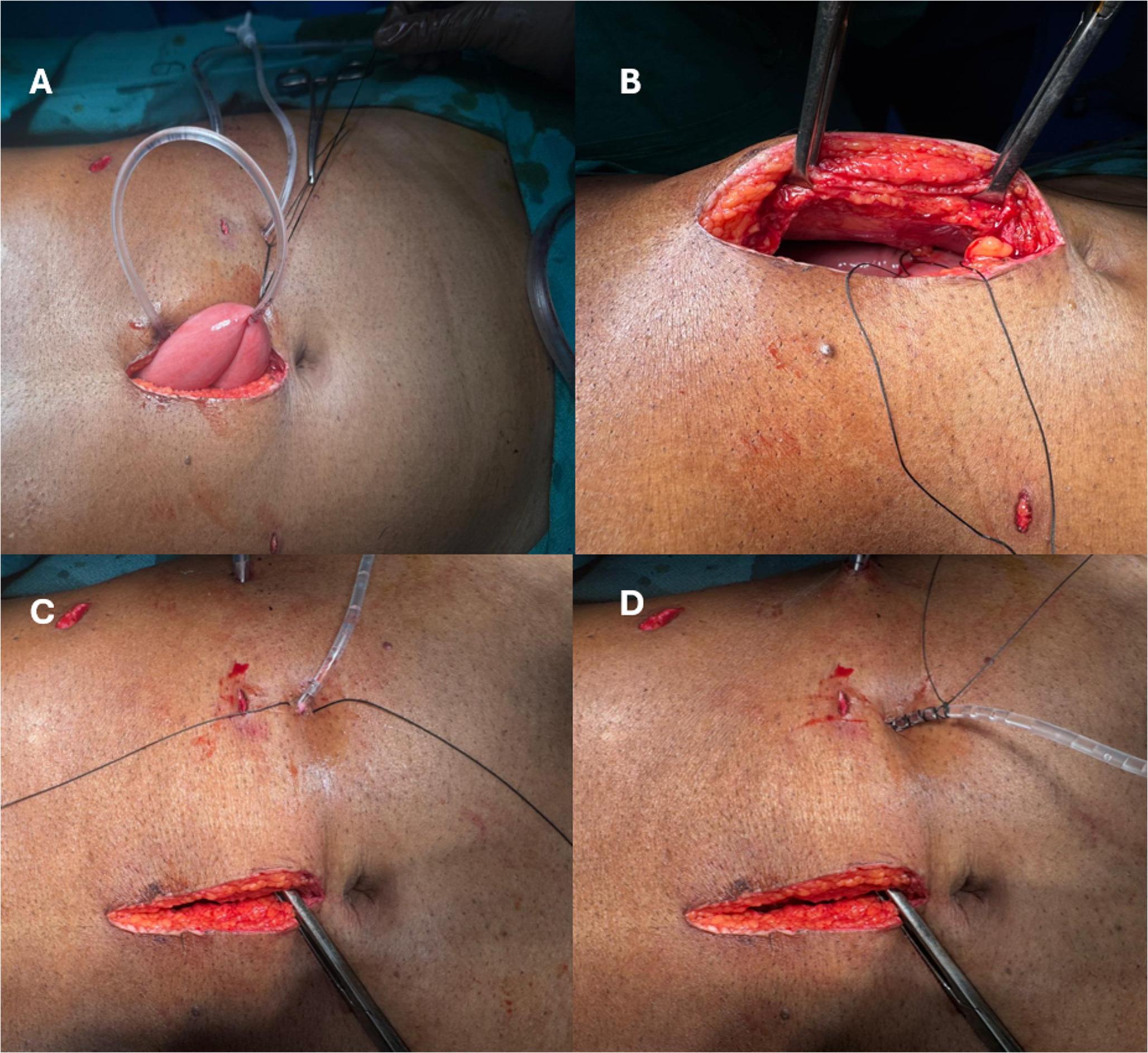 Safety of Feeding Jejunostomy in Patients Undergoing Major Upper Gastrointestinal Surgeries