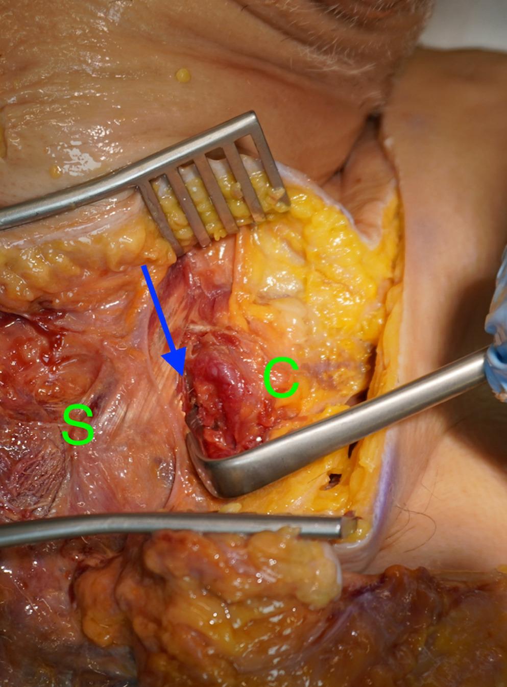 Assessment of a new technique for biological augmentation in sternoclavicular joint dislocations: a cadaveric feasibility and biomechanical evaluation