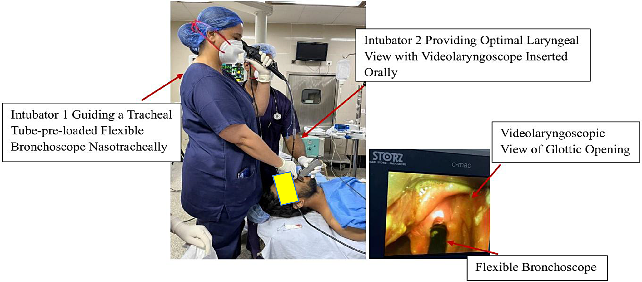 Videolaryngoscope-assisted fibreoptic intubation in anticipated difficult airways of maxillofacial trauma: a prospective randomised comparison with videolaryngoscope-guided nasotracheal intubation
