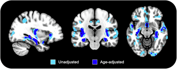 Associations between REM sleep EEG slowing and brain cholinergic denervation in aging and Mild Cognitive Impairment