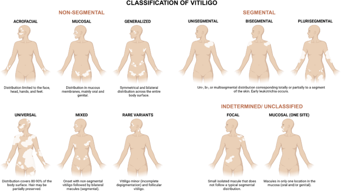 Vitiligo as a Failure of Immune Resolution and Tissue Regeneration: From Stress Signals to Targeted Immune Modulation
