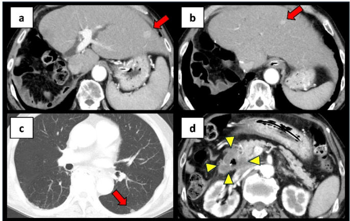Duodenal metastasis of hepatocellular carcinoma following multimodal therapy: a rare case report and literature review