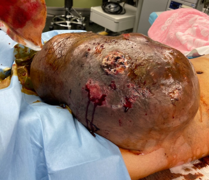 A giant testicular tumor requiring skin valvuloplasty