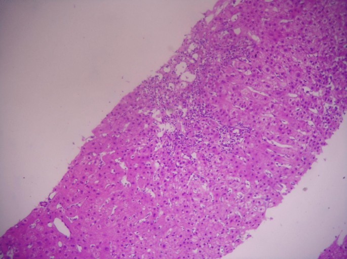 Acute immune-mediated hepatocellular injury temporally associated with romosozumab: a probable autoimmune-like drug-induced liver injury
