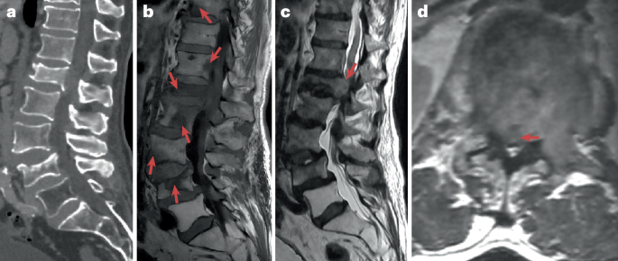 The transformative role of SBRT in the management of spinal metastases