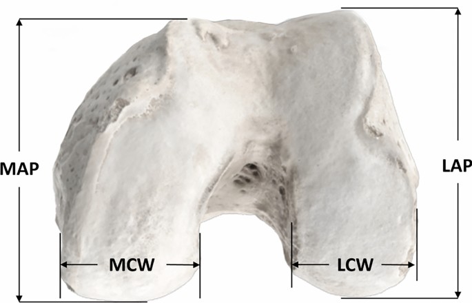 From Virtual to Viable: 3D Bone Banking for Precision Matching in Uncontained Distal Femoral Osteochondral Defects