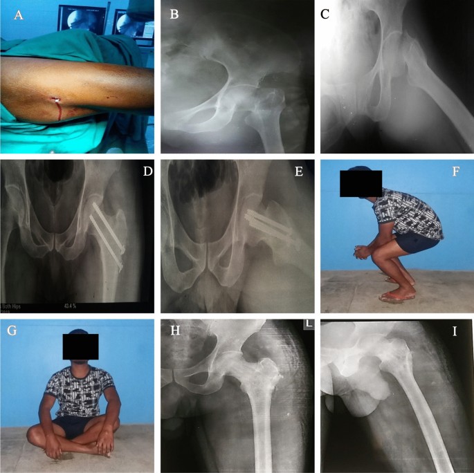 Treatment of Displaced Fracture Neck of Femur by Conventional Parallel Screws (CFIX) and Biplane Double-Supported Screws (BDSF) in Adults: A Prospective Study