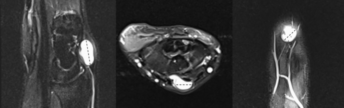 Wrist Ganglion Cyst Localization in Relation to Cyst Size and Associated Injuries: An MRI-Based Retrospective Study