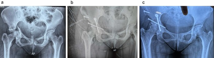 Results of Transverse Acetabular Fracture Fixation with Both Column Screws Only Versus Plate and Column Screw Combination: A Comparative Analysis for Choosing the Best Method