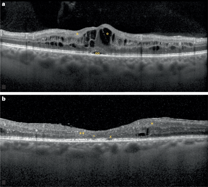 Advances in diagnosing and treating diabetic retinopathy
