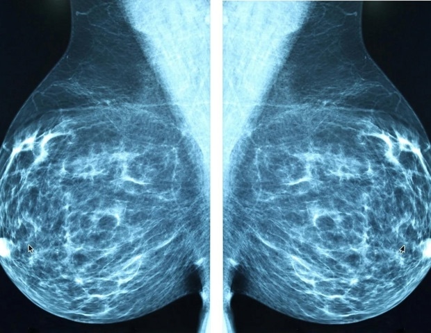 Gene test helps many breast cancer patients avoid chemotherapy