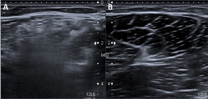 Functional-Sparing Cryoablation for Extensive Fibro-Adipose Vascular Anomaly of the Thigh