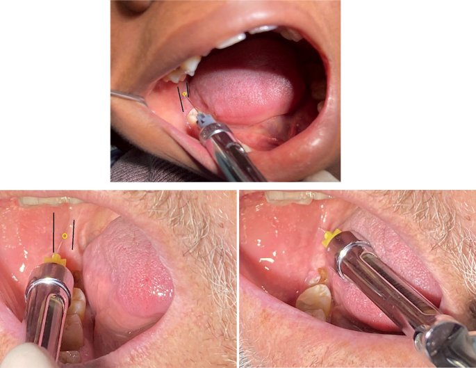 Feasibility Evaluation of a Modified Inferior Alveolar Nerve Block Technique: A Prospective Single-Group Clinical Study
