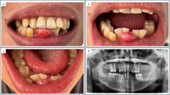 Peripheral Odontogenic Fibroma of the Gingiva Associated with Tooth Displacement: A Clinicopathological Case Report
