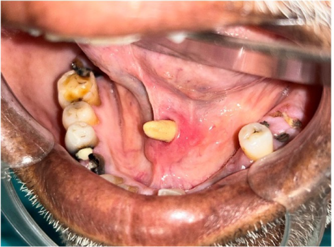 Transoral Removal of a Gigantiform Salivary Calculus of the Submandibular Gland: A Case Report and Review of Literature
