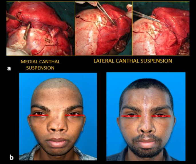 Surgical correction of orbital hypertelorism: a retrospective clinical evaluation of aesthetic outcomes