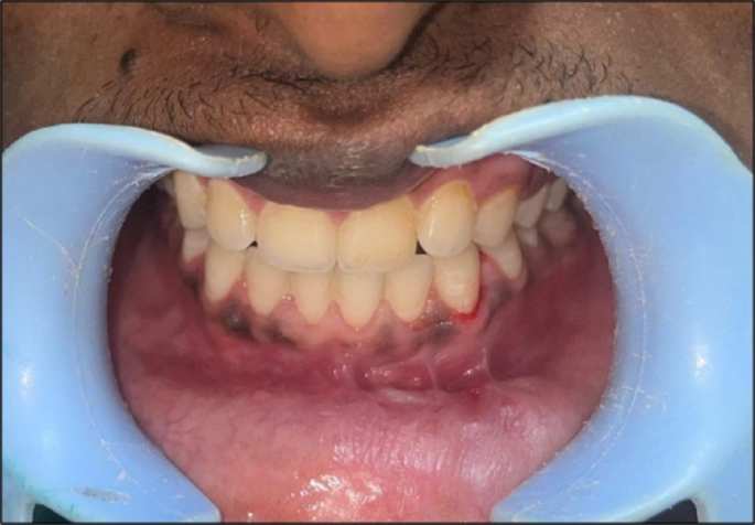 Effect of Triamcinolone and Hyaluronidase on Prevention of Intraoral Fibrosis Following Vestibular Incisions: A Pilot Randomised Controlled Trial
