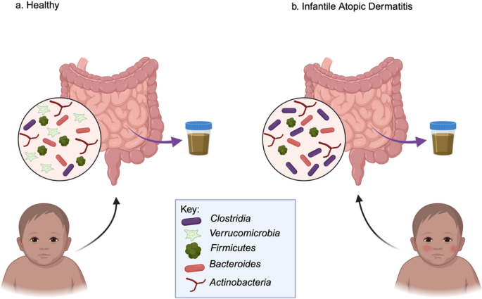 Understanding Infantile Atopic Dermatitis: A Review of Environmental, Familial, Genetic and Microbial Influences