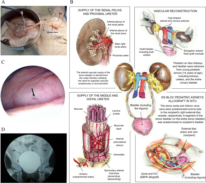 Donor Bladder Inclusion in Kidney Transplantation: A Review of the Literature and our Clinical Experience