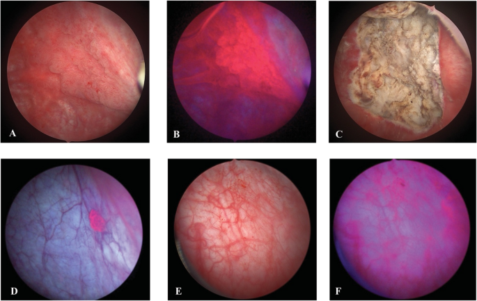 Contemporary Role for Blue Light Cystoscopy Across the Bladder Cancer Disease Spectrum