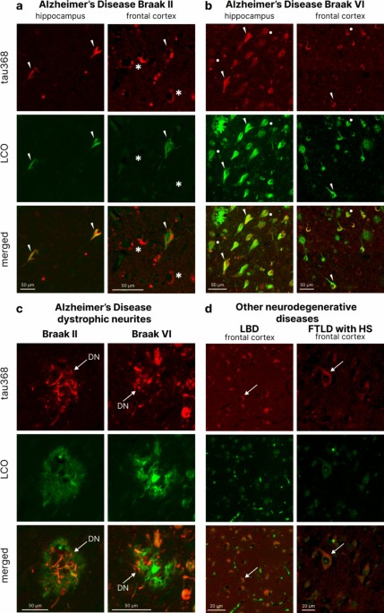 Tau368 improves p-tau diagnostic accuracy for FTLD-tau from FTLD-TDP
