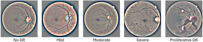 Hybrid deep learning models for diabetic retinopathy stage classification using fundus images