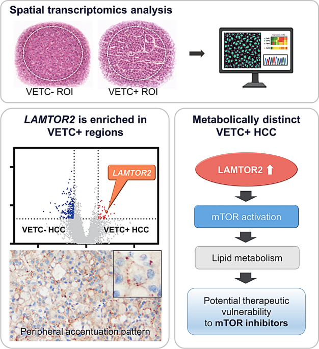 Spatial analysis identifies  overexpression in hepatocellular carcinoma with vessels encapsulating tumor clusters