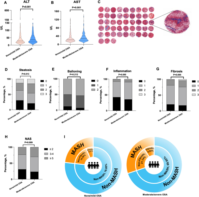 Obstructive sleep apnea mediates the association between body mass index and metabolic dysfunction-associated steatotic liver disease in patients with obesity