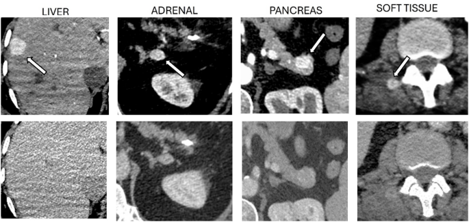 Multimodality staging of renal cell carcinoma—pearls & pitfalls