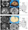 Location- and ADC-based stratification of transition zone PI-RADS 3 lesions to optimize biopsy indication