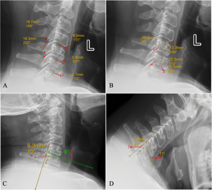 Radiograph-based intervertebral sagittal translation-to-canal diameter ratio as a quantitative imaging marker for suspected lower cervical instability