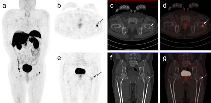 Osteomalacia Caused by a Phosphaturic Mesenchymal Tumor Detected by F-AlF-NOTA-octreotide PET/CT