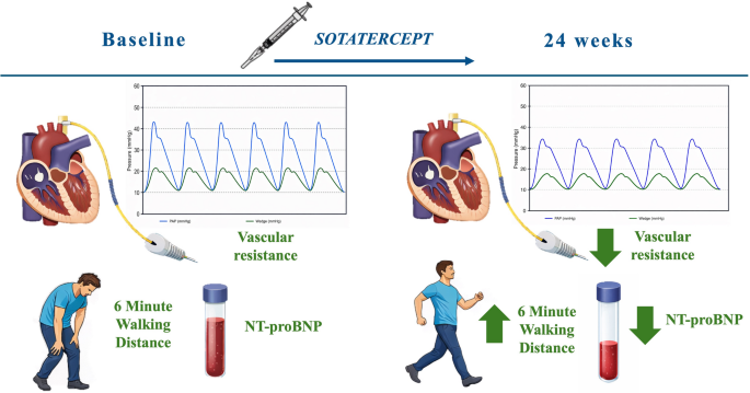 Beyond vasodilation: sotatercept and the remodeling hypothesis in hfpef-associated pulmonary hypertension