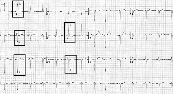 Clinical implications of left anterior fascicular block for cardiac remodeling in hypertensive patients