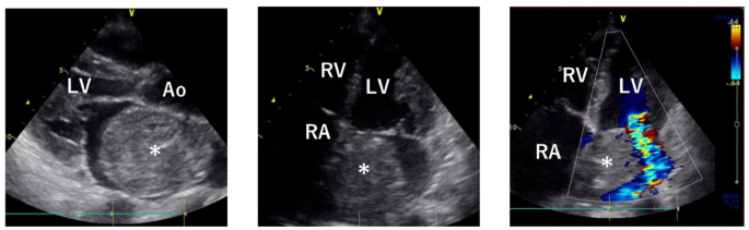 A case of a giant left atrial myxoma with mitral regurgitation resulting in heart failure and improved left atrial remodeling after surgery