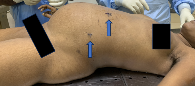 Giant jejunal gastrointestinal stromal tumour (GIST) in a young female: a fatal case of diagnostic delay revealed at autopsy