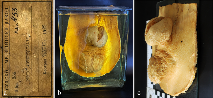 Contemporary imaging analysis of a pioneering case of post-traumatic total penile reconstruction from the early 20th century