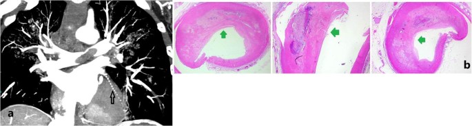 Multiphase post-mortem CT angiography (MPMCTA) in sudden natural death: diagnostic contribution and workflow impact in a forensic autopsy series