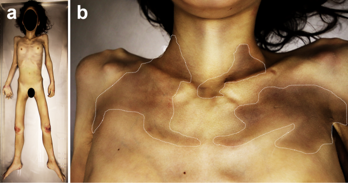 Recognizing pellagra with Casal’s necklace: a fatal case of anorexia nervosa