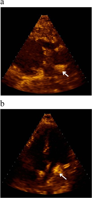 A rare bilateral spontaneous severe hemothorax in intramural hematoma type B with unremarkable aortic histology: a case report and literature review